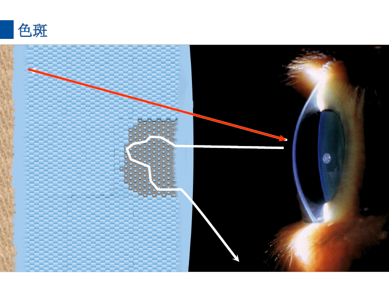 dmg口腔材料怎么使用德国DMG  Icon 渗透树脂，应该这样用……_https://www.jmylbn.com_新闻资讯_第13张