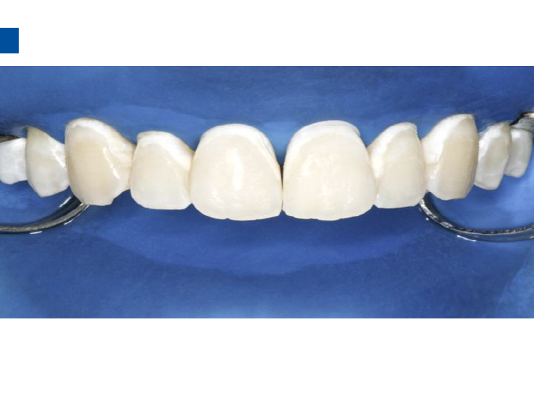 dmg口腔材料怎么使用德国DMG  Icon 渗透树脂，应该这样用……_https://www.jmylbn.com_新闻资讯_第77张