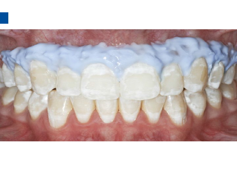 dmg口腔材料怎么使用德国DMG  Icon 渗透树脂，应该这样用……_https://www.jmylbn.com_新闻资讯_第74张