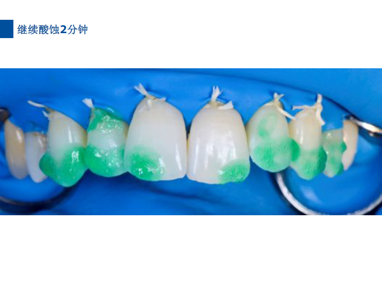 dmg口腔材料怎么使用德国DMG  Icon 渗透树脂，应该这样用……_https://www.jmylbn.com_新闻资讯_第57张