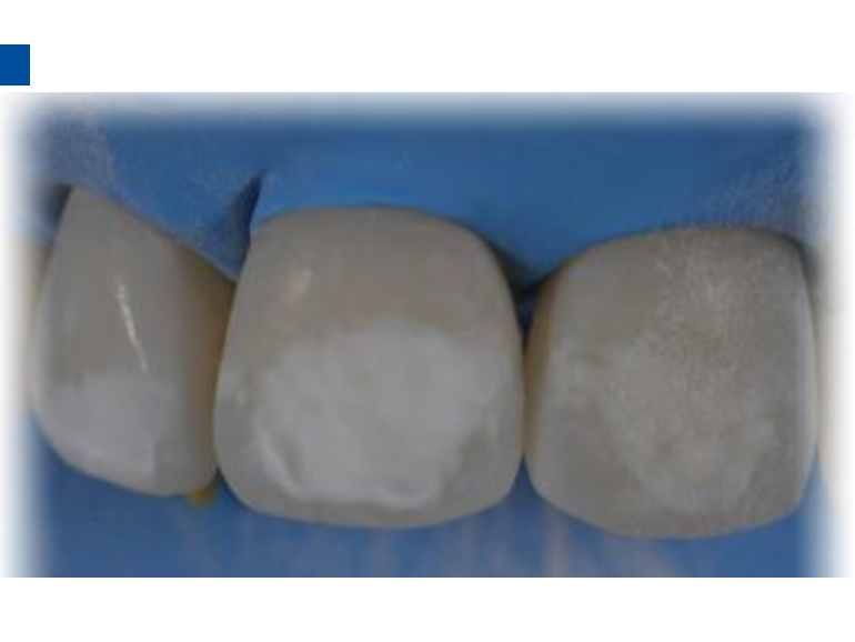 dmg口腔材料怎么使用德国DMG  Icon 渗透树脂，应该这样用……_https://www.jmylbn.com_新闻资讯_第66张