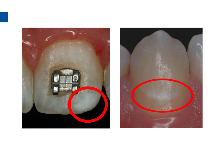 dmg口腔材料怎么使用德国DMG  Icon 渗透树脂，应该这样用……_https://www.jmylbn.com_新闻资讯_第48张