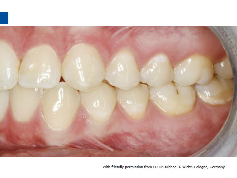 dmg口腔材料怎么使用德国DMG  Icon 渗透树脂，应该这样用……_https://www.jmylbn.com_新闻资讯_第19张