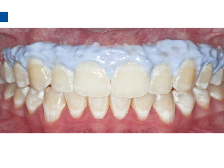 dmg口腔材料怎么使用德国DMG  Icon 渗透树脂，应该这样用……_https://www.jmylbn.com_新闻资讯_第76张