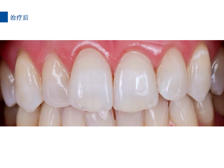 dmg口腔材料怎么使用德国DMG  Icon 渗透树脂，应该这样用……_https://www.jmylbn.com_新闻资讯_第63张