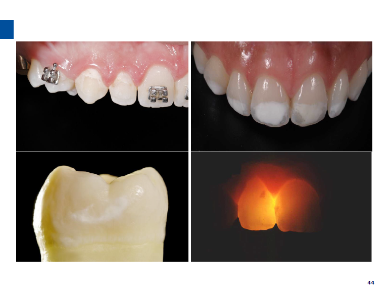 dmg口腔材料怎么使用德国DMG  Icon 渗透树脂，应该这样用……_https://www.jmylbn.com_新闻资讯_第45张
