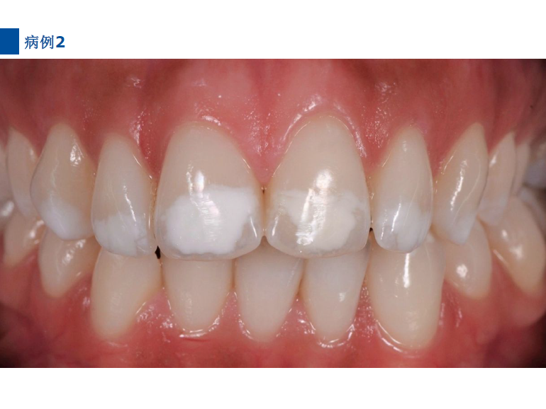 dmg口腔材料怎么使用德国DMG  Icon 渗透树脂，应该这样用……_https://www.jmylbn.com_新闻资讯_第65张