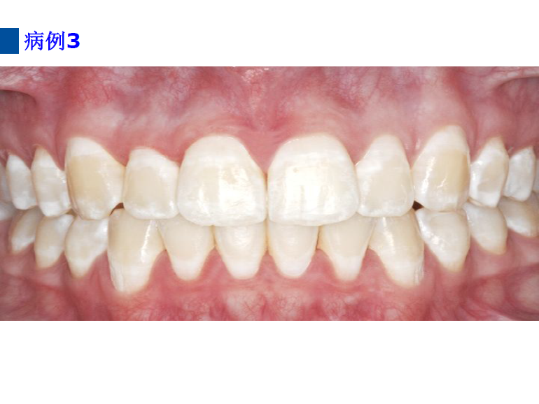 dmg口腔材料怎么使用德国DMG  Icon 渗透树脂，应该这样用……_https://www.jmylbn.com_新闻资讯_第73张