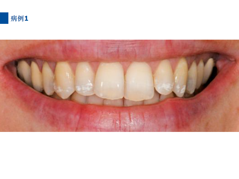 dmg口腔材料怎么使用德国DMG  Icon 渗透树脂，应该这样用……_https://www.jmylbn.com_新闻资讯_第51张