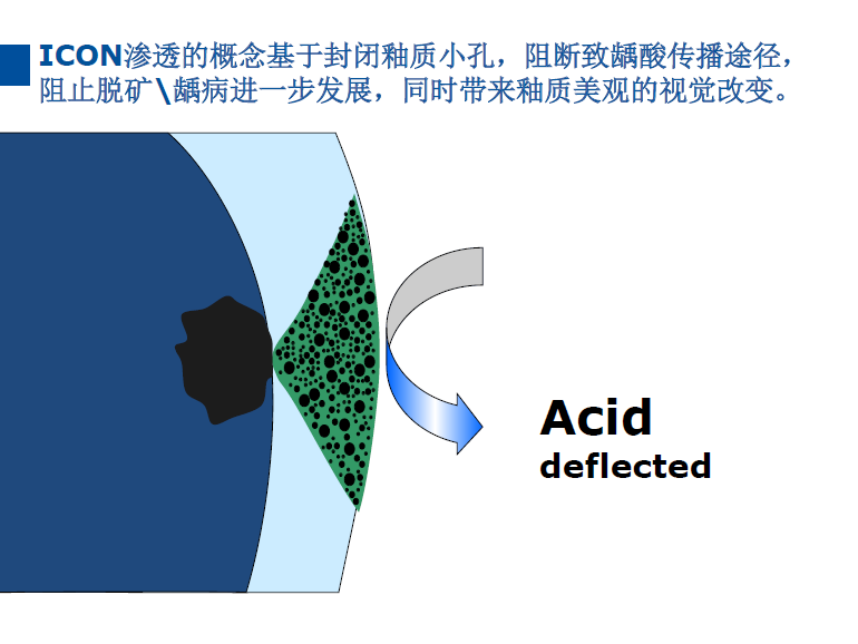dmg口腔材料怎么使用德国DMG  Icon 渗透树脂，应该这样用……_https://www.jmylbn.com_新闻资讯_第34张