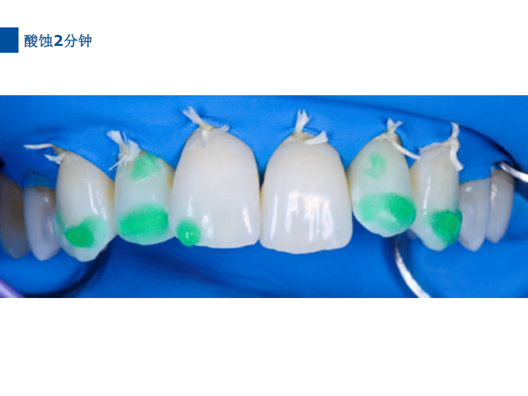 dmg口腔材料怎么使用德国DMG  Icon 渗透树脂，应该这样用……_https://www.jmylbn.com_新闻资讯_第54张