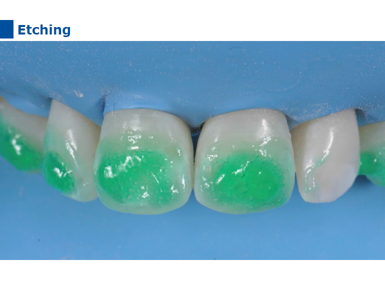 dmg口腔材料怎么使用德国DMG  Icon 渗透树脂，应该这样用……_https://www.jmylbn.com_新闻资讯_第68张