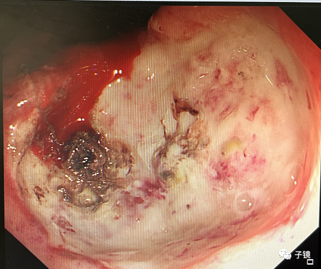 什么是电凝止血“非静脉曲张性消化道出血内镜止血宝典”学习笔记_https://www.jmylbn.com_新闻资讯_第15张