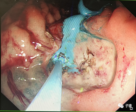 什么是电凝止血“非静脉曲张性消化道出血内镜止血宝典”学习笔记_https://www.jmylbn.com_新闻资讯_第16张