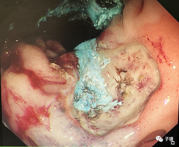 什么是电凝止血“非静脉曲张性消化道出血内镜止血宝典”学习笔记_https://www.jmylbn.com_新闻资讯_第17张