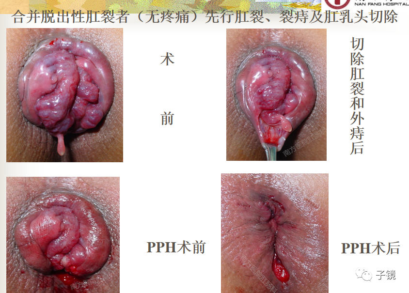痔疮吻合钉长什么样南方医院李胜龙教授“肛肠外科微创治痔大全”学习笔记_https://www.jmylbn.com_新闻资讯_第18张