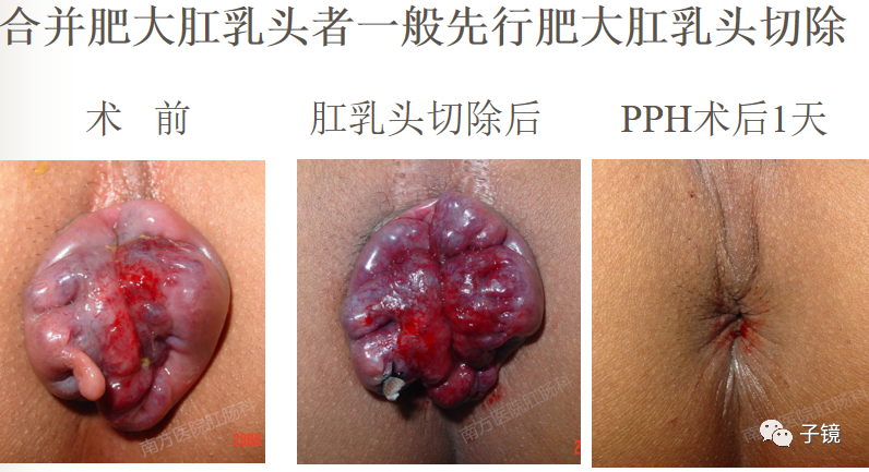 痔疮吻合钉长什么样南方医院李胜龙教授“肛肠外科微创治痔大全”学习笔记_https://www.jmylbn.com_新闻资讯_第14张