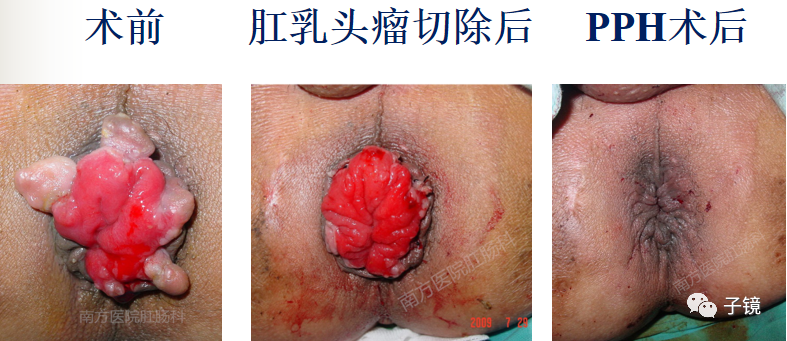 痔疮吻合钉长什么样南方医院李胜龙教授“肛肠外科微创治痔大全”学习笔记_https://www.jmylbn.com_新闻资讯_第15张