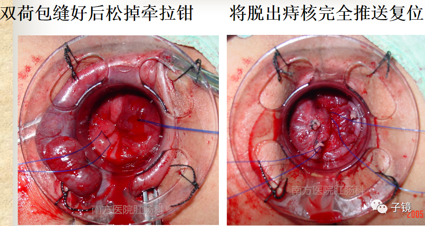 痔疮吻合钉长什么样南方医院李胜龙教授“肛肠外科微创治痔大全”学习笔记_https://www.jmylbn.com_新闻资讯_第21张