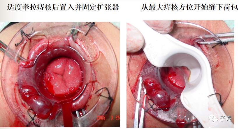 痔疮吻合钉长什么样南方医院李胜龙教授“肛肠外科微创治痔大全”学习笔记_https://www.jmylbn.com_新闻资讯_第20张