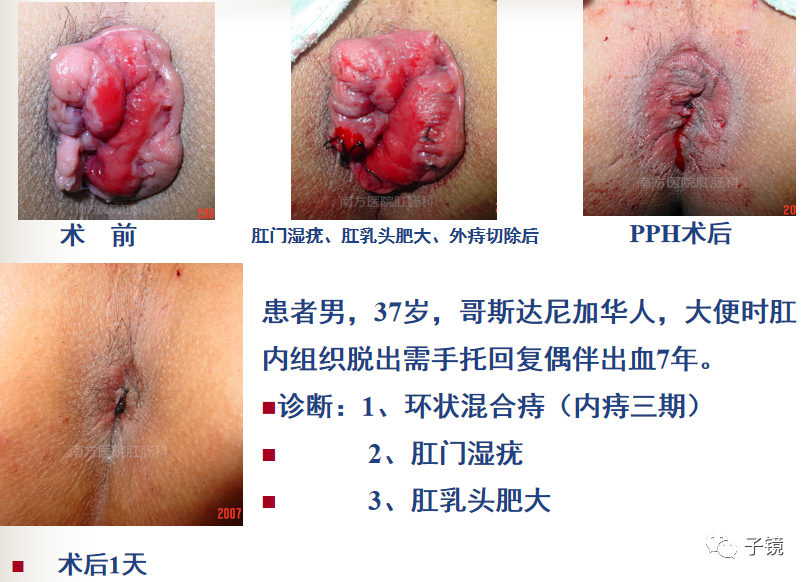 痔疮吻合钉长什么样南方医院李胜龙教授“肛肠外科微创治痔大全”学习笔记_https://www.jmylbn.com_新闻资讯_第17张