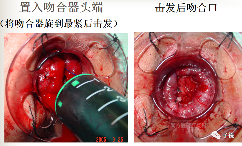 痔疮吻合钉长什么样南方医院李胜龙教授“肛肠外科微创治痔大全”学习笔记_https://www.jmylbn.com_新闻资讯_第22张