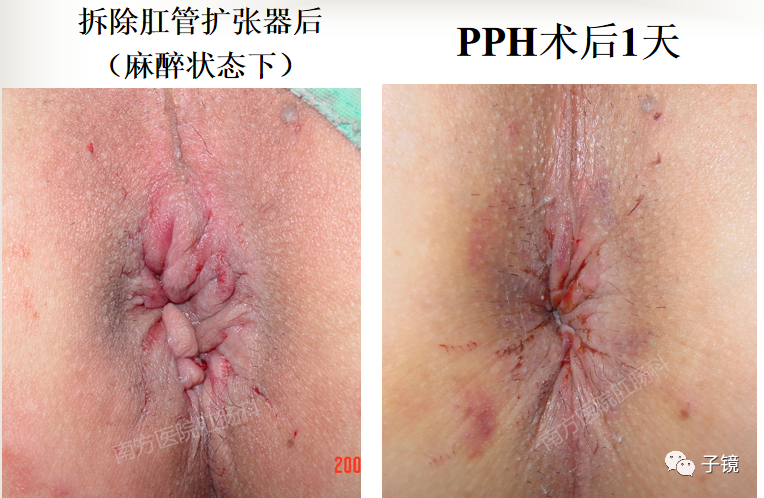 痔疮吻合钉长什么样南方医院李胜龙教授“肛肠外科微创治痔大全”学习笔记_https://www.jmylbn.com_新闻资讯_第23张