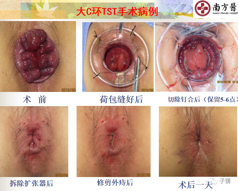 痔疮吻合钉长什么样南方医院李胜龙教授“肛肠外科微创治痔大全”学习笔记_https://www.jmylbn.com_新闻资讯_第27张