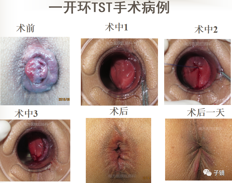 痔疮吻合钉长什么样南方医院李胜龙教授“肛肠外科微创治痔大全”学习笔记_https://www.jmylbn.com_新闻资讯_第24张