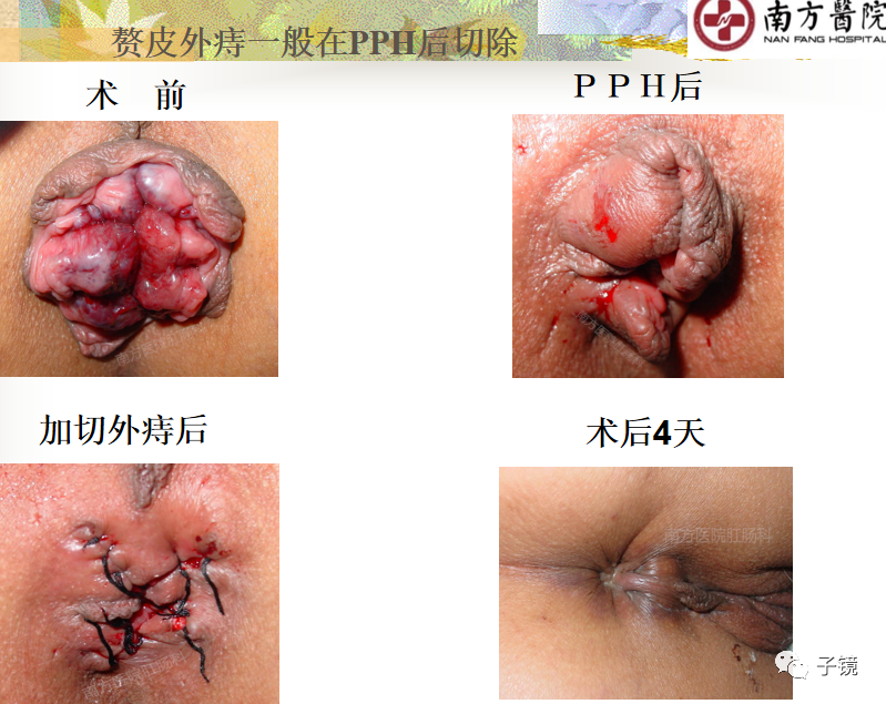 痔疮吻合钉长什么样南方医院李胜龙教授“肛肠外科微创治痔大全”学习笔记_https://www.jmylbn.com_新闻资讯_第11张