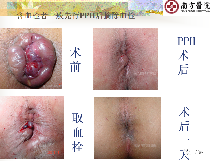 痔疮吻合钉长什么样南方医院李胜龙教授“肛肠外科微创治痔大全”学习笔记_https://www.jmylbn.com_新闻资讯_第10张