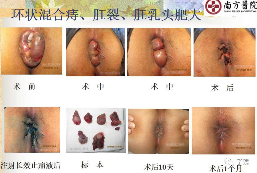 痔疮吻合钉长什么样南方医院李胜龙教授“肛肠外科微创治痔大全”学习笔记_https://www.jmylbn.com_新闻资讯_第5张