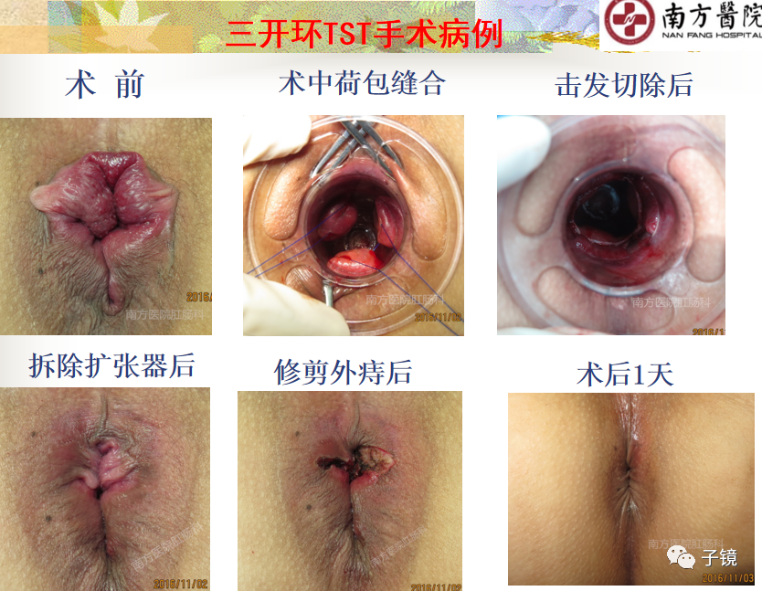 痔疮吻合钉长什么样南方医院李胜龙教授“肛肠外科微创治痔大全”学习笔记_https://www.jmylbn.com_新闻资讯_第26张