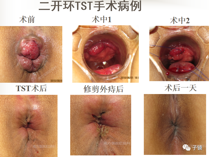 痔疮吻合钉长什么样南方医院李胜龙教授“肛肠外科微创治痔大全”学习笔记_https://www.jmylbn.com_新闻资讯_第25张