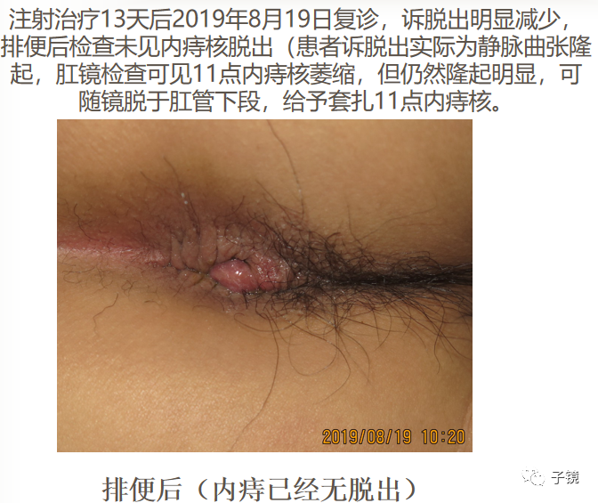 痔疮吻合钉长什么样南方医院李胜龙教授“肛肠外科微创治痔大全”学习笔记_https://www.jmylbn.com_新闻资讯_第31张