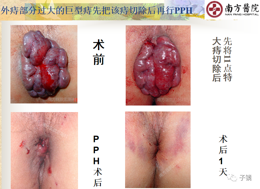 痔疮吻合钉长什么样南方医院李胜龙教授“肛肠外科微创治痔大全”学习笔记_https://www.jmylbn.com_新闻资讯_第8张