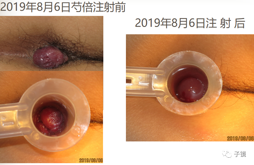 痔疮吻合钉长什么样南方医院李胜龙教授“肛肠外科微创治痔大全”学习笔记_https://www.jmylbn.com_新闻资讯_第30张