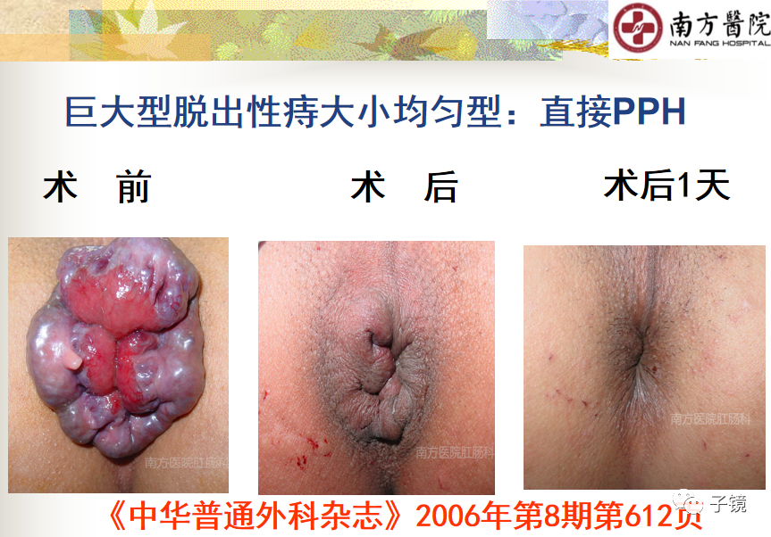 痔疮吻合钉长什么样南方医院李胜龙教授“肛肠外科微创治痔大全”学习笔记_https://www.jmylbn.com_新闻资讯_第6张