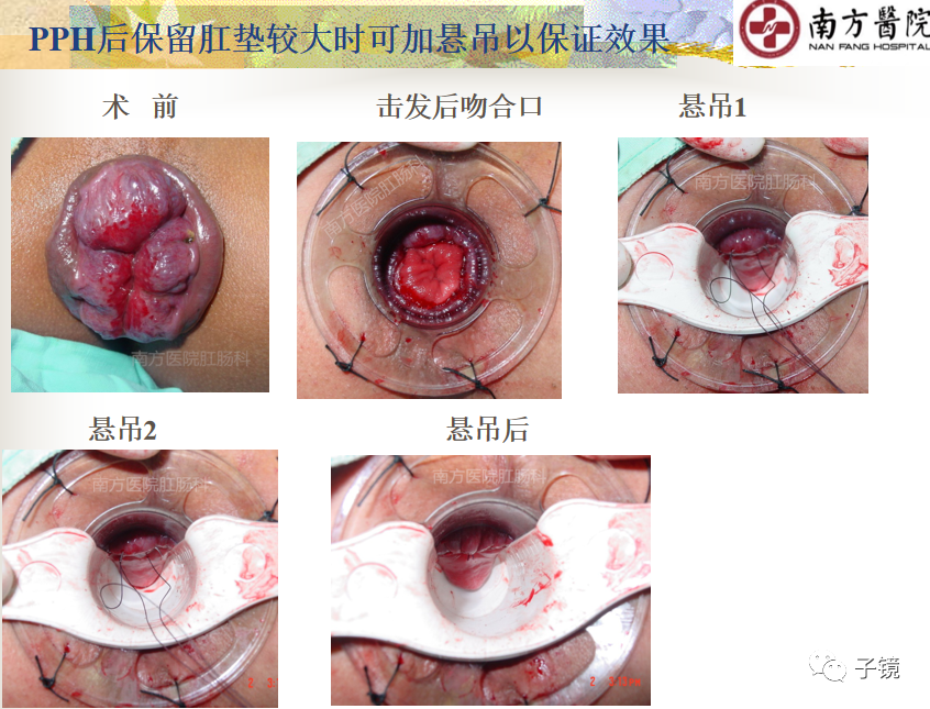 痔疮吻合钉长什么样南方医院李胜龙教授“肛肠外科微创治痔大全”学习笔记_https://www.jmylbn.com_新闻资讯_第9张
