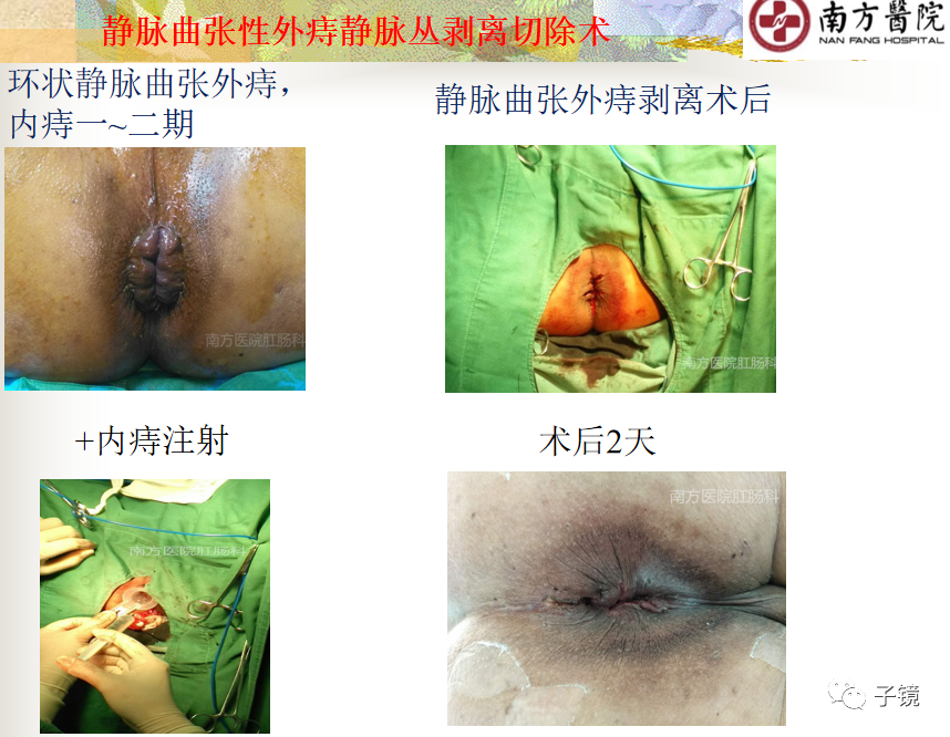 痔疮吻合钉长什么样南方医院李胜龙教授“肛肠外科微创治痔大全”学习笔记_https://www.jmylbn.com_新闻资讯_第3张
