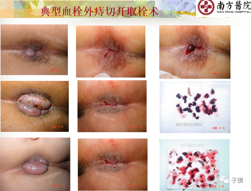 痔疮吻合钉长什么样南方医院李胜龙教授“肛肠外科微创治痔大全”学习笔记_https://www.jmylbn.com_新闻资讯_第39张
