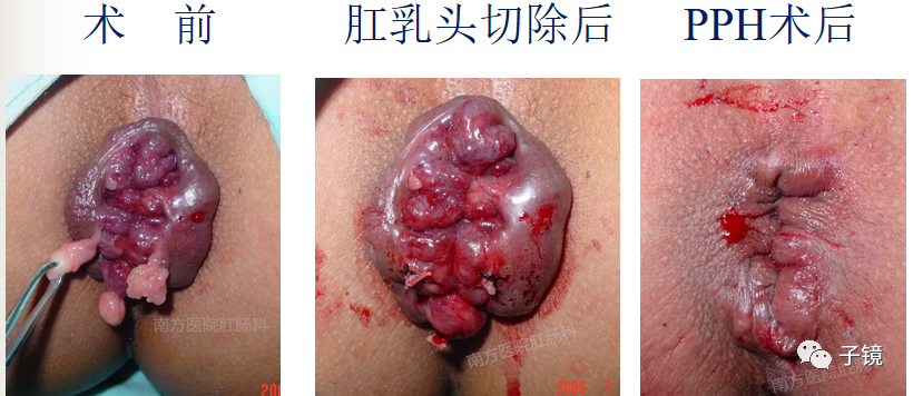 痔疮吻合钉长什么样南方医院李胜龙教授“肛肠外科微创治痔大全”学习笔记_https://www.jmylbn.com_新闻资讯_第16张