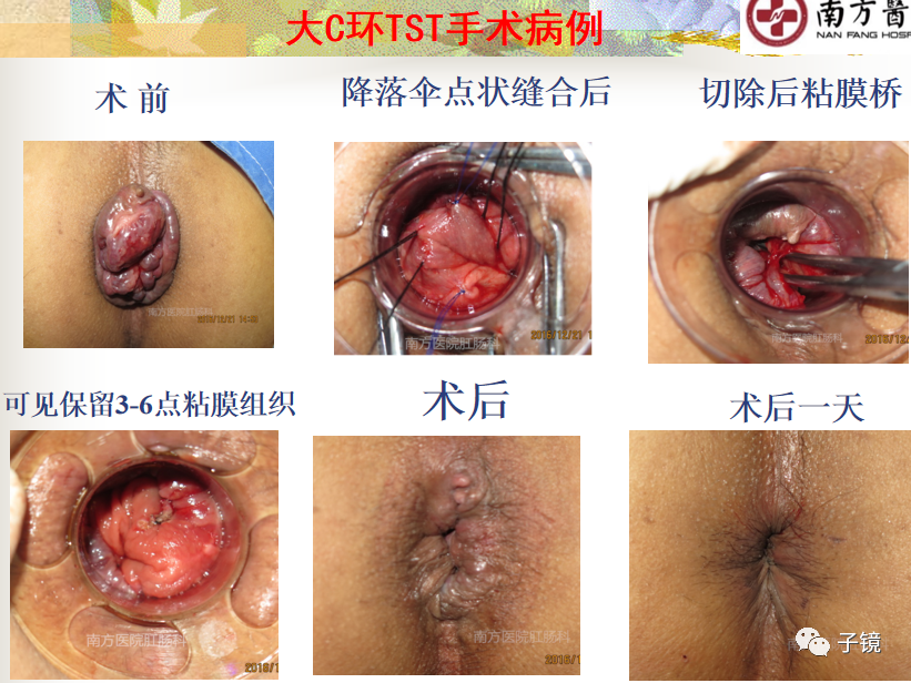 痔疮吻合钉长什么样南方医院李胜龙教授“肛肠外科微创治痔大全”学习笔记_https://www.jmylbn.com_新闻资讯_第28张