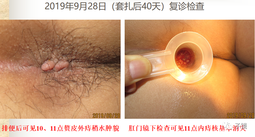 痔疮吻合钉长什么样南方医院李胜龙教授“肛肠外科微创治痔大全”学习笔记_https://www.jmylbn.com_新闻资讯_第33张