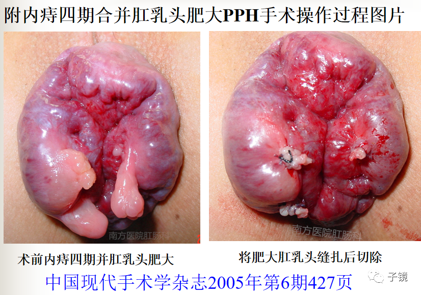 痔疮吻合钉长什么样南方医院李胜龙教授“肛肠外科微创治痔大全”学习笔记_https://www.jmylbn.com_新闻资讯_第19张