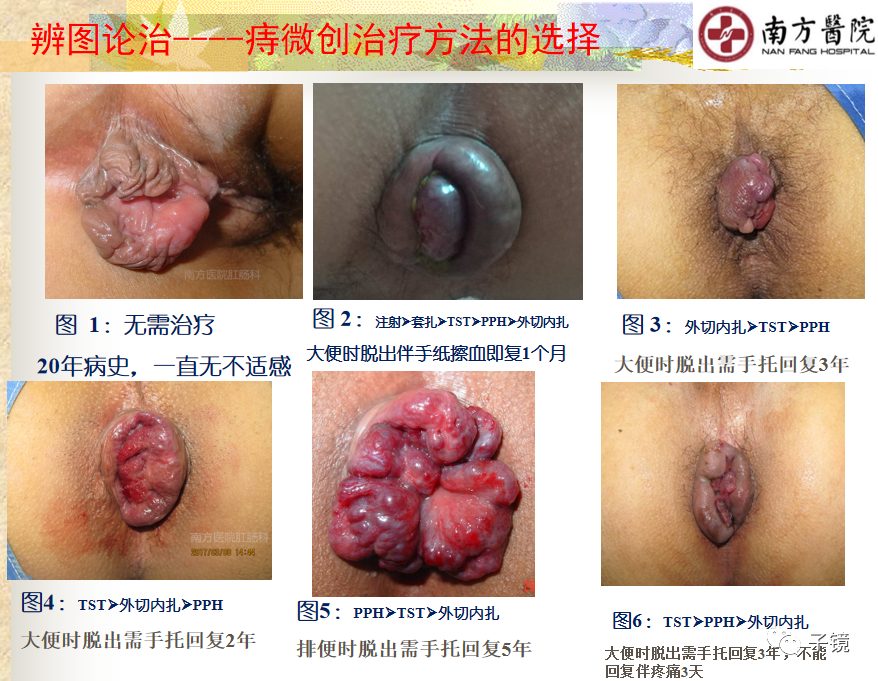 痔疮吻合钉长什么样南方医院李胜龙教授“肛肠外科微创治痔大全”学习笔记_https://www.jmylbn.com_新闻资讯_第40张