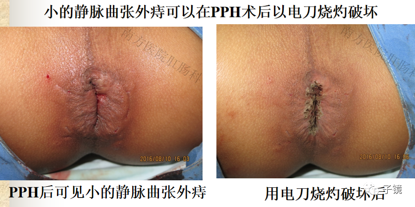 痔疮吻合钉长什么样南方医院李胜龙教授“肛肠外科微创治痔大全”学习笔记_https://www.jmylbn.com_新闻资讯_第13张