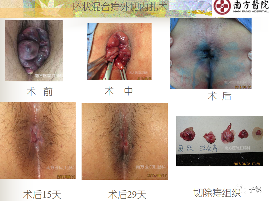 痔疮吻合钉长什么样南方医院李胜龙教授“肛肠外科微创治痔大全”学习笔记_https://www.jmylbn.com_新闻资讯_第4张