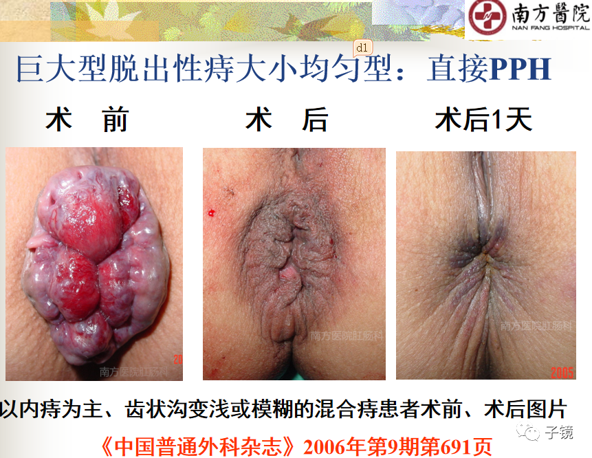 痔疮吻合钉长什么样南方医院李胜龙教授“肛肠外科微创治痔大全”学习笔记_https://www.jmylbn.com_新闻资讯_第7张