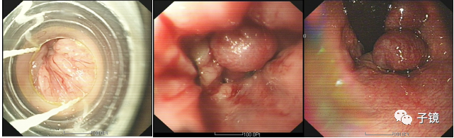 套扎环怎么下“中美专家谈内痔内镜下套扎治疗”学习笔记_https://www.jmylbn.com_新闻资讯_第18张